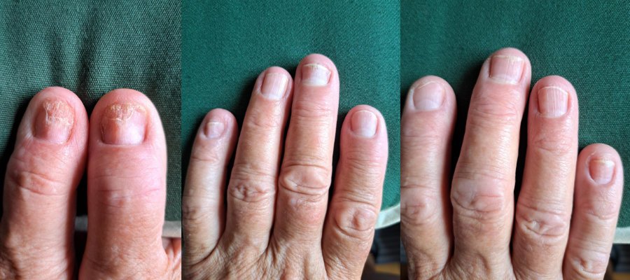 3 manader efter behandling